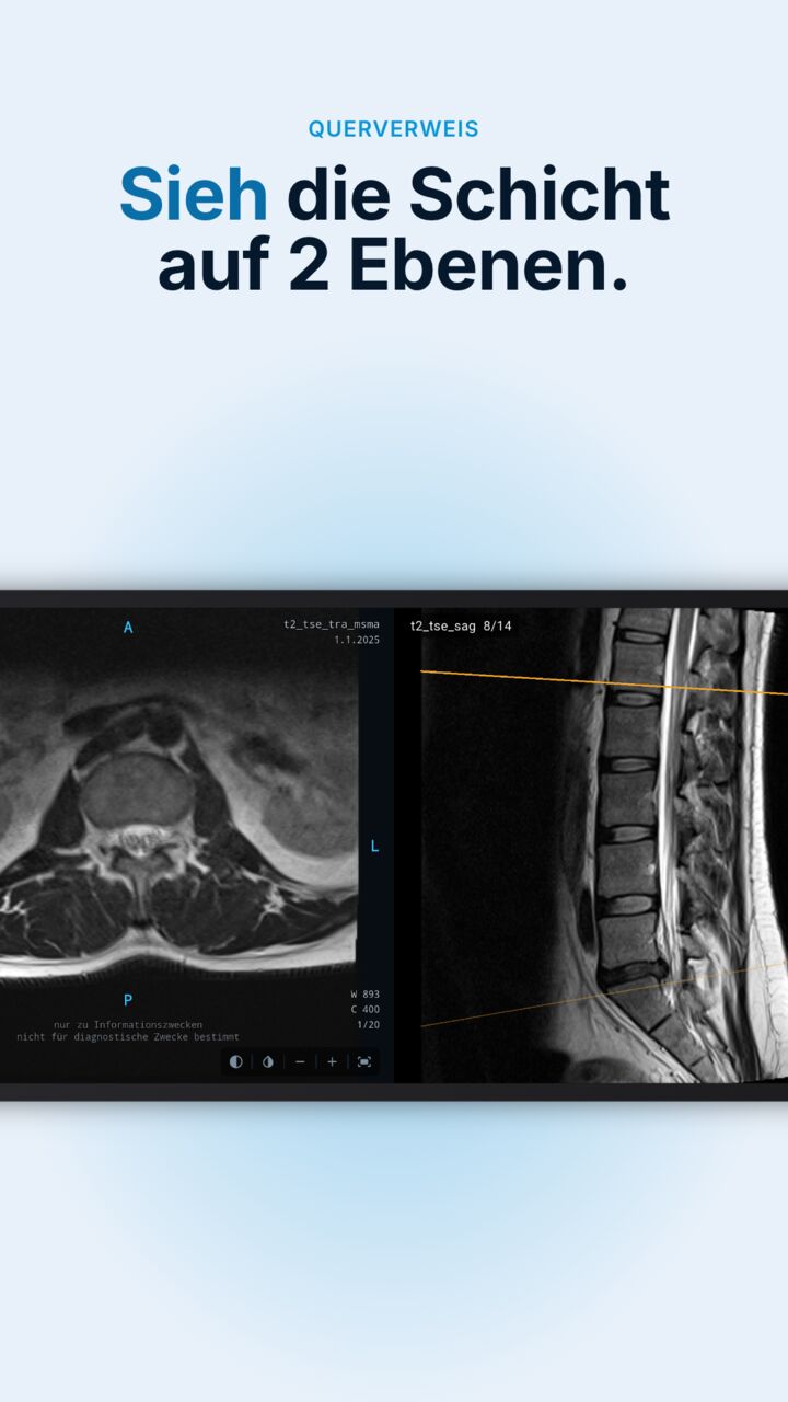 Radix DICOM zeigt eine axiale und eine sagittale MRT der Wirbelsäule mit je einer Referenzlinie
