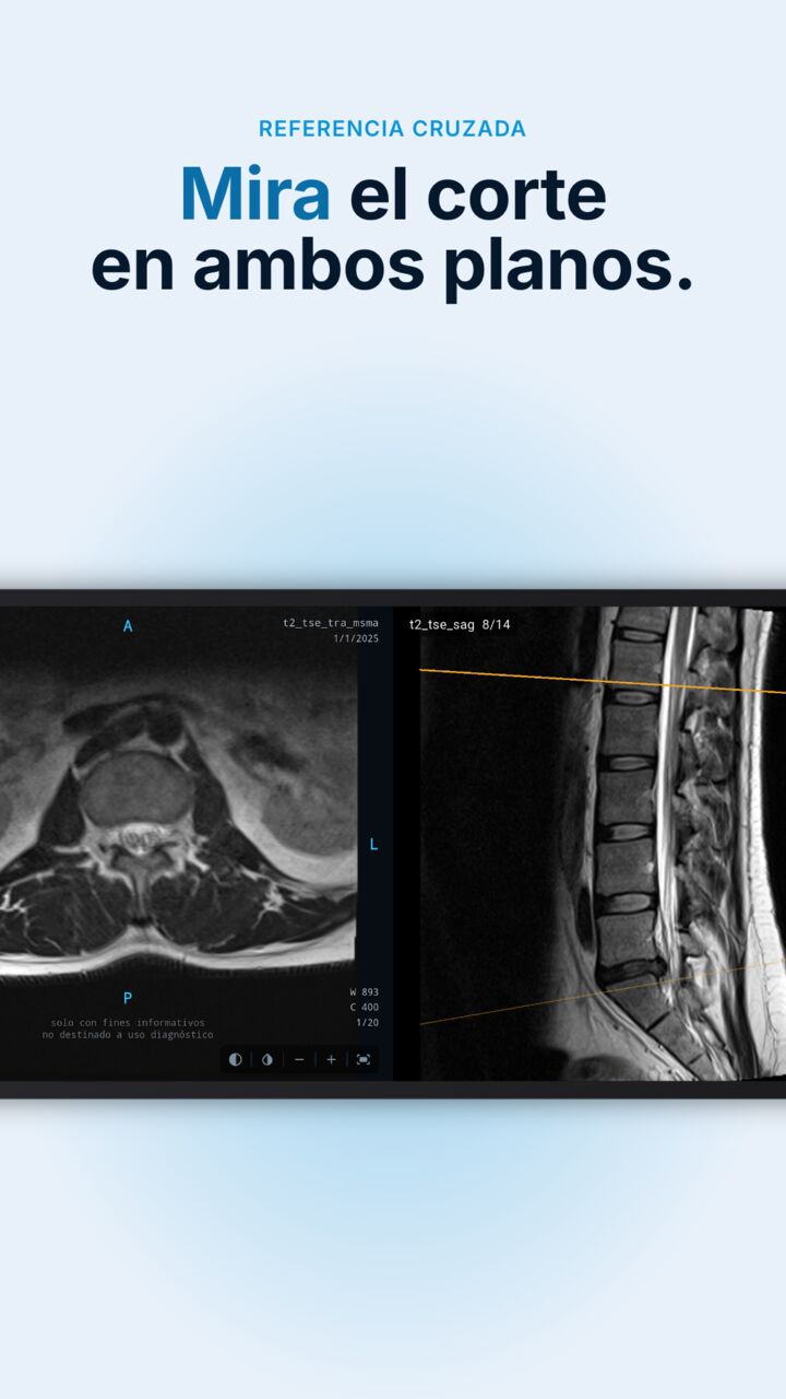Radix DICOM mostrando una RM axial y una sagital de la columna con una línea de referencia en cada una