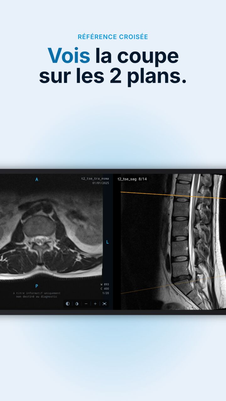 Radix DICOM affichant une IRM axiale et une IRM sagittale du rachis, chacune avec une ligne de référence