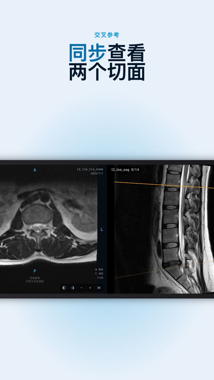 Radix DICOM 同时显示脊柱的轴位和矢状位 MRI,每幅图上各有一条参考线
